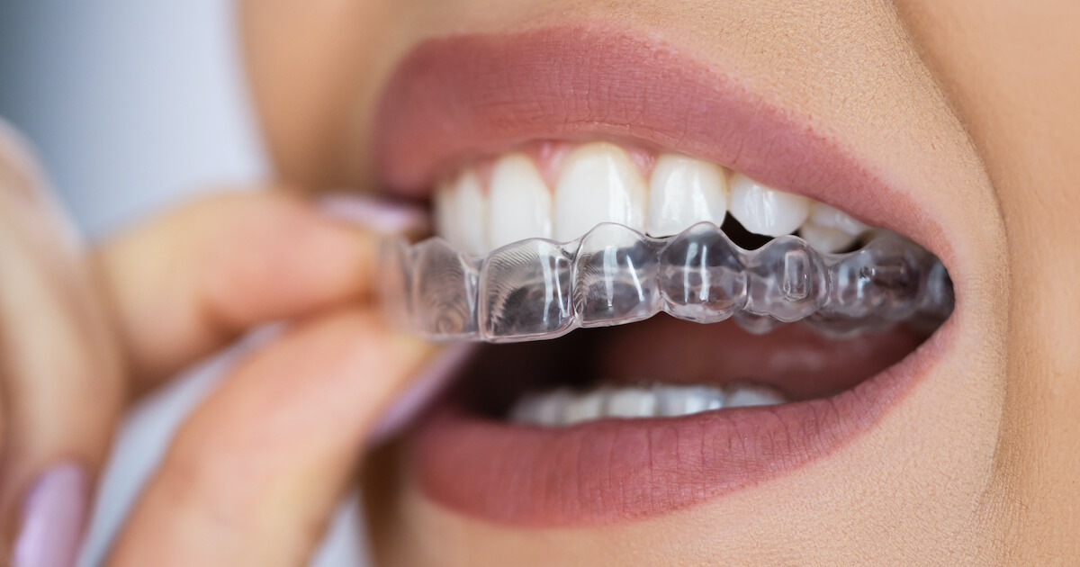 INVISALIGN